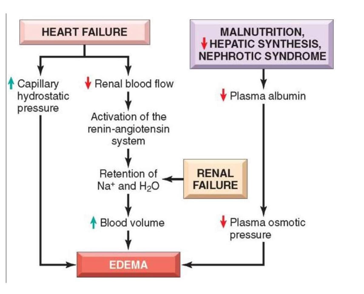 HEART FAILURE
Capillary
hydrostatic
pressure
Renal blood flow
Activation of the
renin-angiotensin
system
Retention of
Na+ and H₂O
Blood volume
↓
EDEMA
MALNUTRITION,
HEPATIC SYNTHESIS,
NEPHROTIC SYNDROME
Plasma albumin
RENAL
FAILURE
Plasma osmotic
pressure
