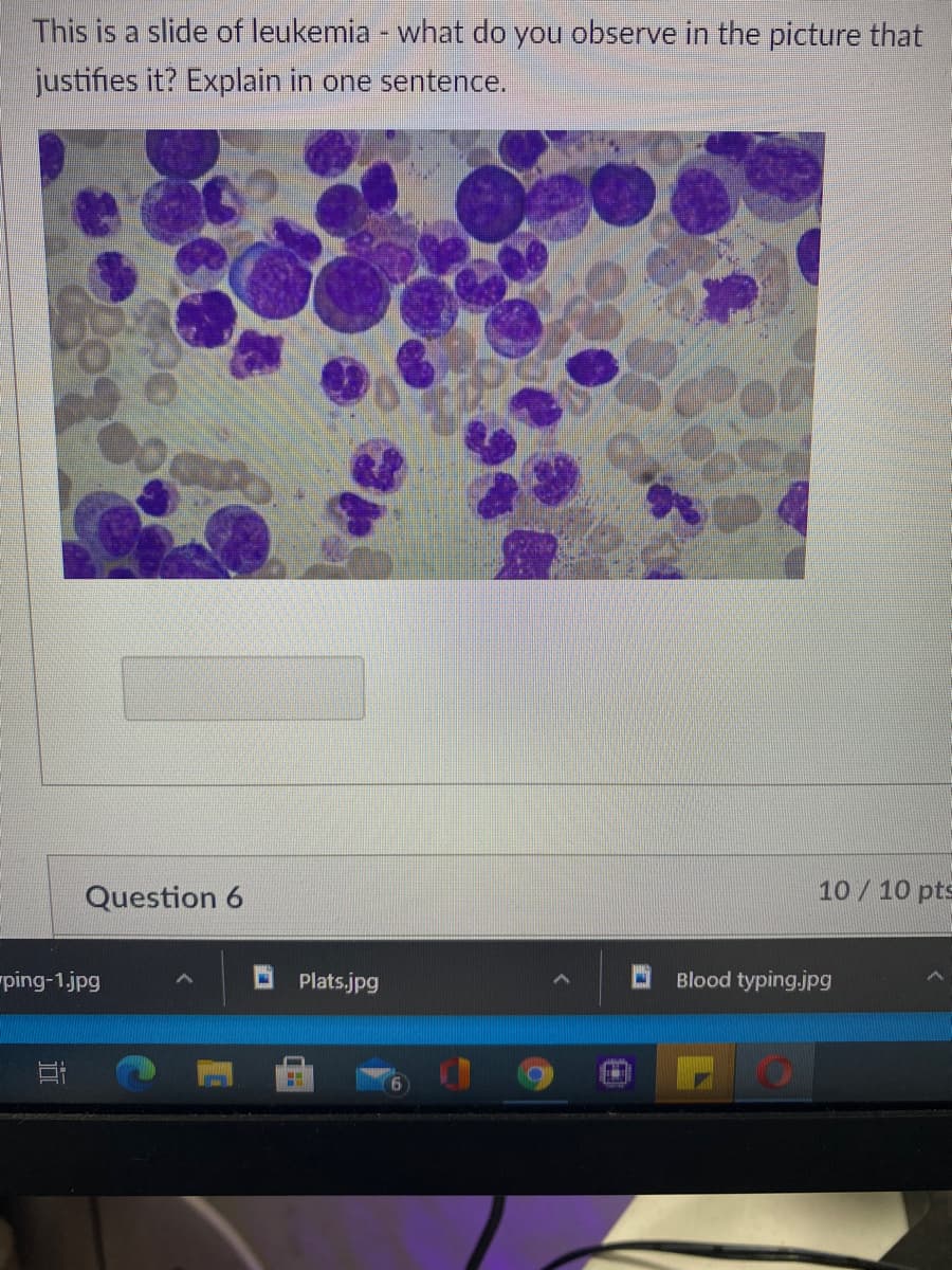 This is a slide of leukemia - what do you observe in the picture that
justifies it? Explain in one sentence.
