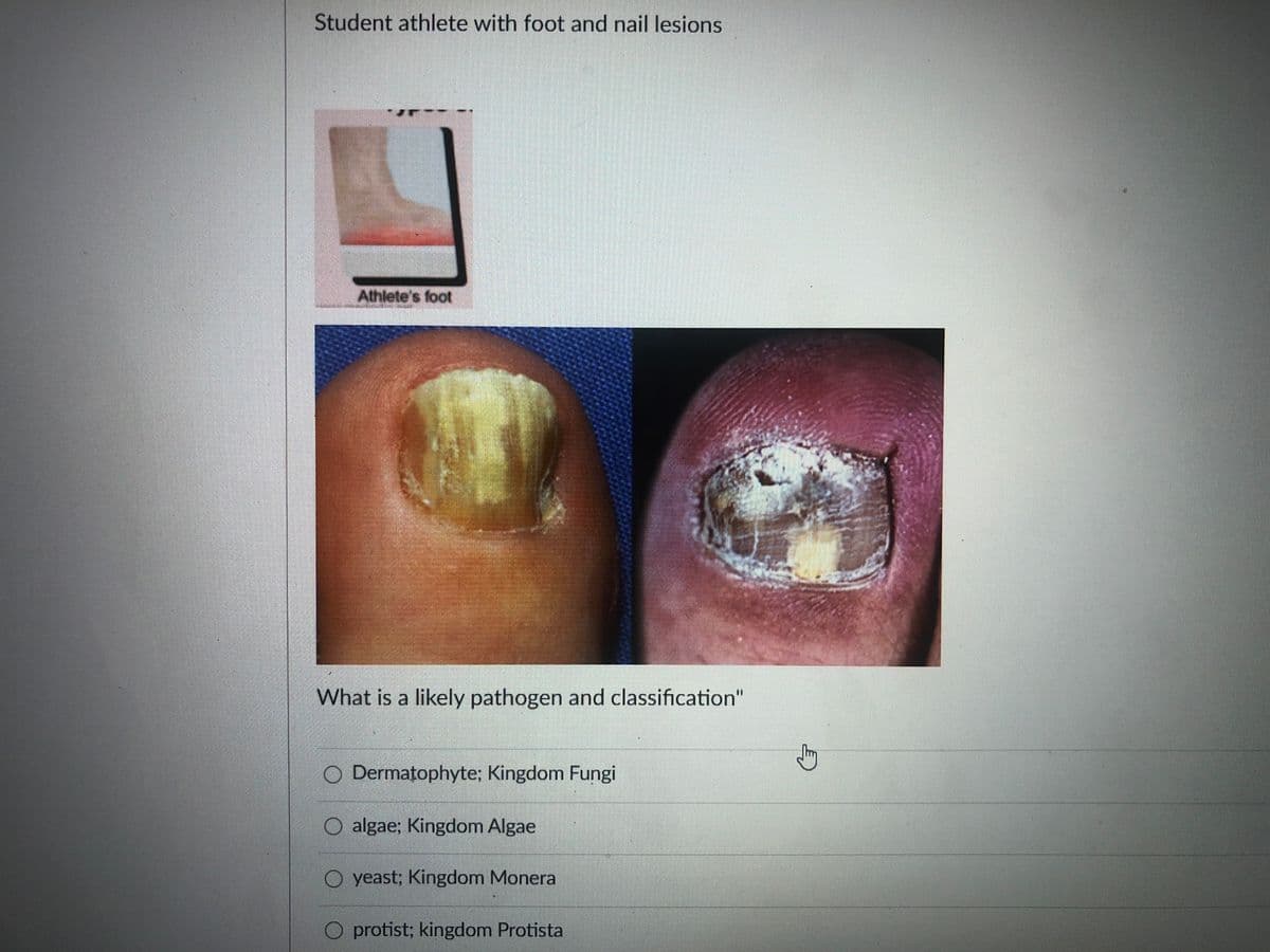 Student athlete with foot and nail lesions
Athlete's foot
What is a likely pathogen and classification"
O Dermatophyte; Kingdom Fungi
O algae; Kingdom Algae
O yeast; Kingdom Monera
protist; kingdom Protista
