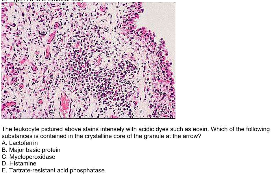 The leukocyte pictured above stains intensely with acidic dyes such as eosin. Which of the following
substances is contained in the crystalline core of the granule at the arrow?
A. Lactoferrin
B. Major basic protein
C. Myeloperoxidase
D. Histamine
E. Tartrate-resistant acid phosphatase