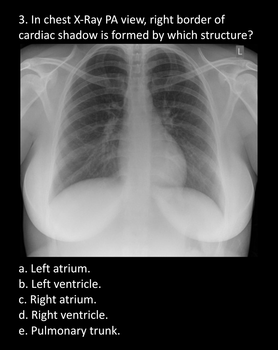 3. In chest X-Ray PA view, right border of
cardiac shadow is formed by which structure?
L
a. Left atrium.
b. Left ventricle.
c. Right atrium.
d. Right ventricle.
e. Pulmonary trunk.