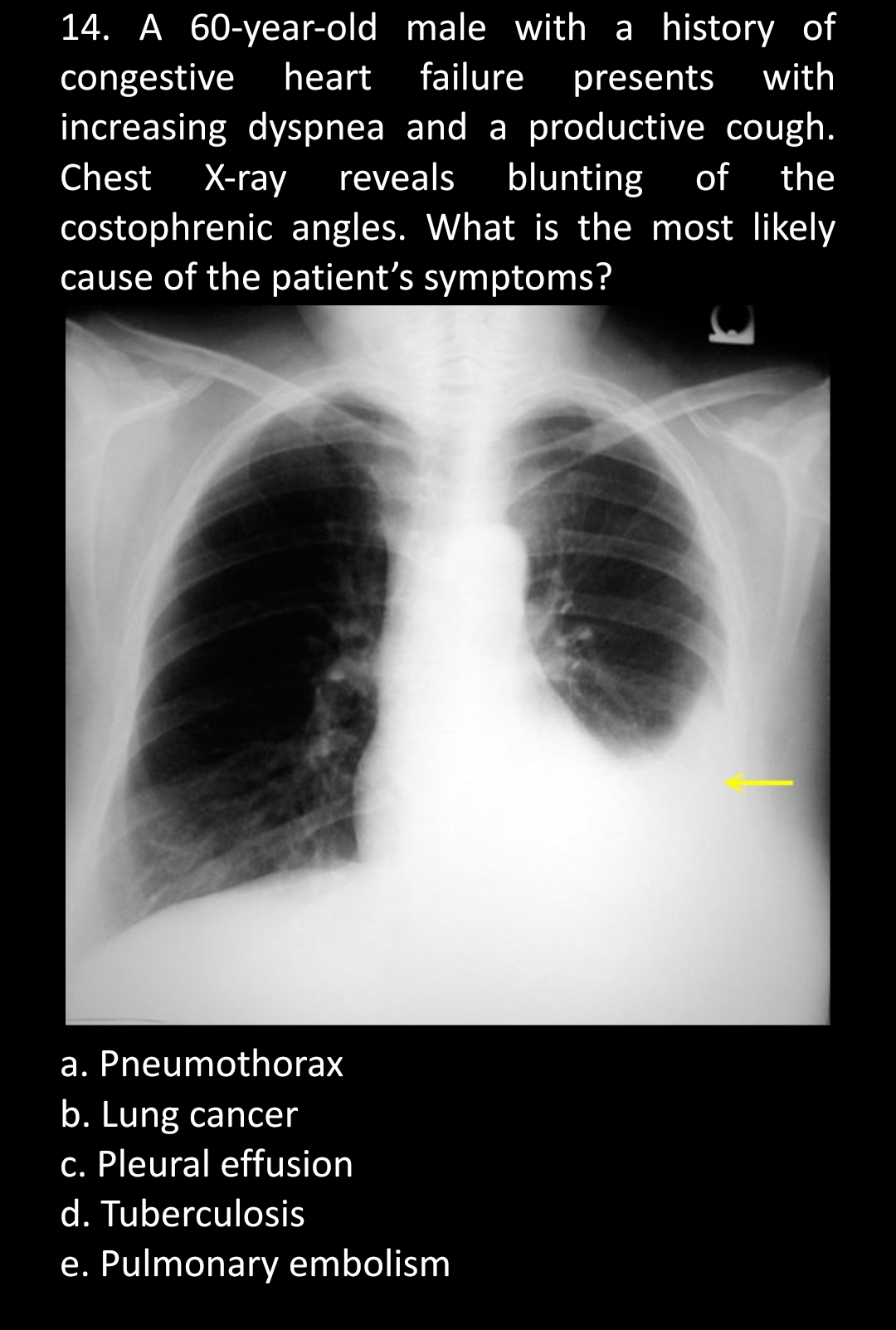 14. A 60-year-old male with a history of
congestive heart failure presents with
increasing dyspnea and a productive cough.
Chest X-ray reveals blunting of the
costophrenic angles. What is the most likely
cause of the patient's symptoms?
a. Pneumothorax
b. Lung cancer
c. Pleural effusion
d. Tuberculosis
e. Pulmonary embolism