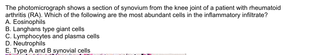 The photomicrograph shows a section of synovium from the knee joint of a patient with rheumatoid
arthritis (RA). Which of the following are the most abundant cells in the inflammatory infiltrate?
A. Eosinophils
B. Langhans type giant cells
C. Lymphocytes and plasma cells
D. Neutrophils
E. Type A and B synovial cells