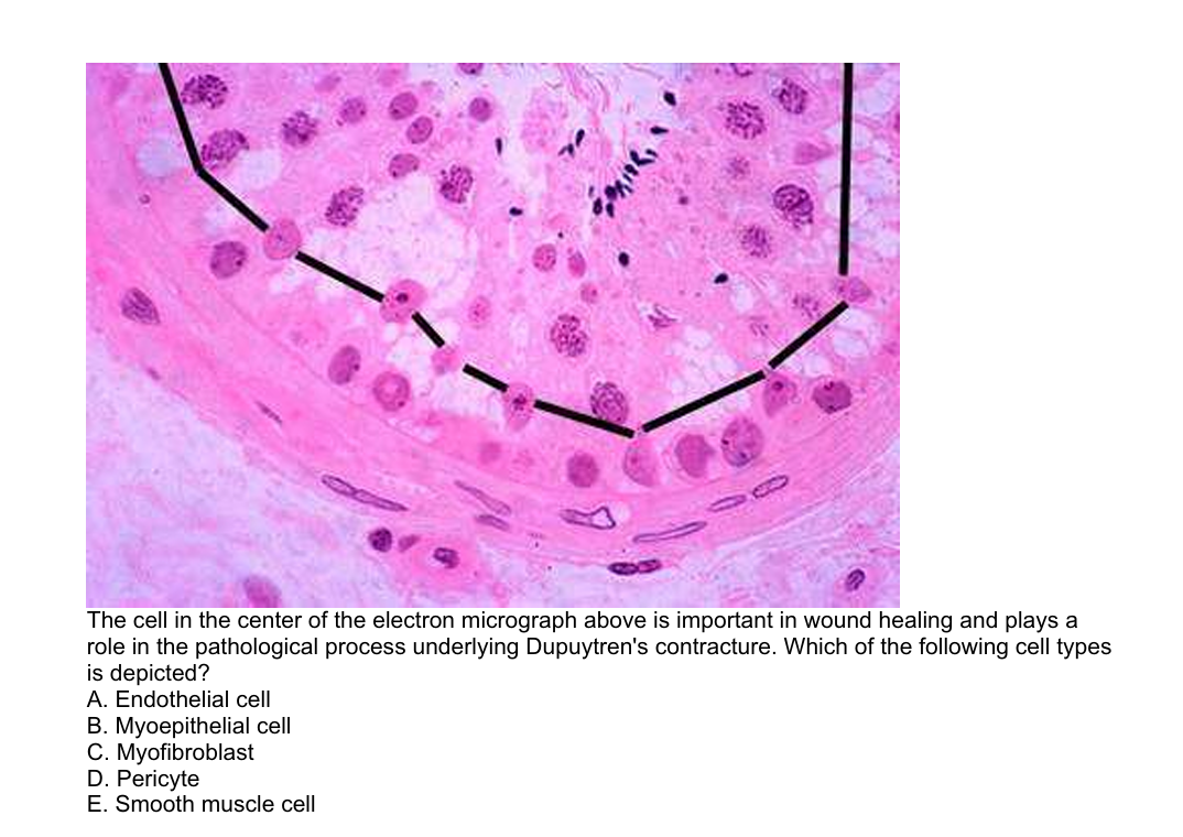 The cell in the center of the electron micrograph above is important in wound healing and plays a
role in the pathological process underlying Dupuytren's contracture. Which of the following cell types
is depicted?
A. Endothelial cell
B. Myoepithelial cell
C. Myofibroblast
D. Pericyte
E. Smooth muscle cell