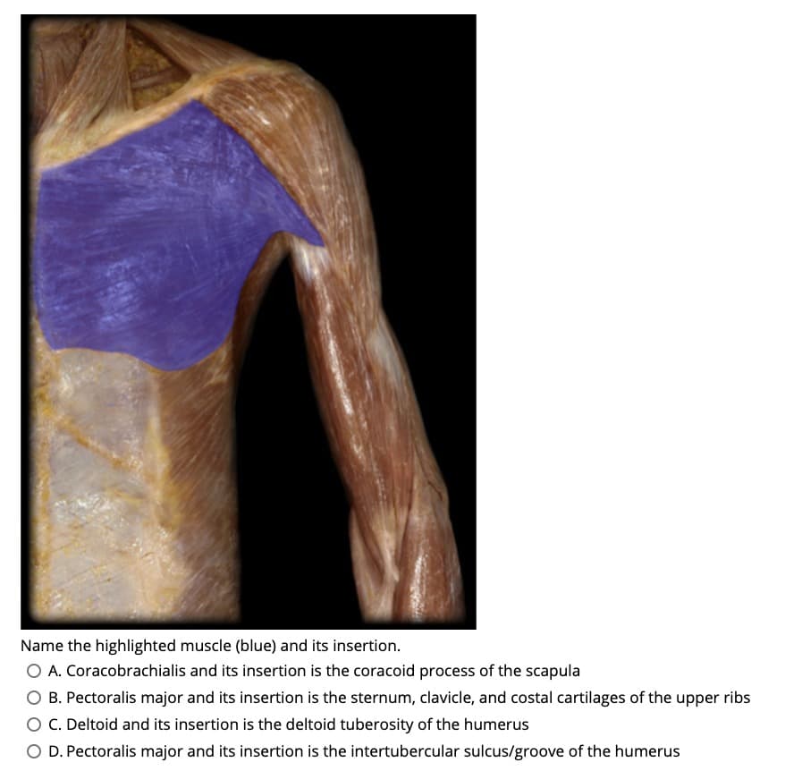 Name the highlighted muscle (blue) and its insertion.
O A. Coracobrachialis and its insertion is the coracoid process of the scapula
O B. Pectoralis major and its insertion is the sternum, clavicle, and costal cartilages of the upper ribs
O C. Deltoid and its insertion is the deltoid tuberosity of the humerus
O D. Pectoralis major and its insertion is the intertubercular sulcus/groove of the humerus
