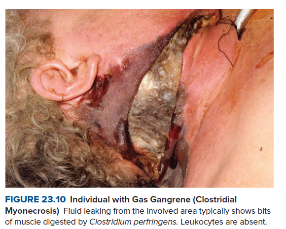 FIGURE 23.10 Individual with Gas Gangrene (Clostridial
Myonecrosis) Fluid leaking from the involved area typically shows bits
of muscle digested by Clostridium perfringens. Leukocytes are absent.
