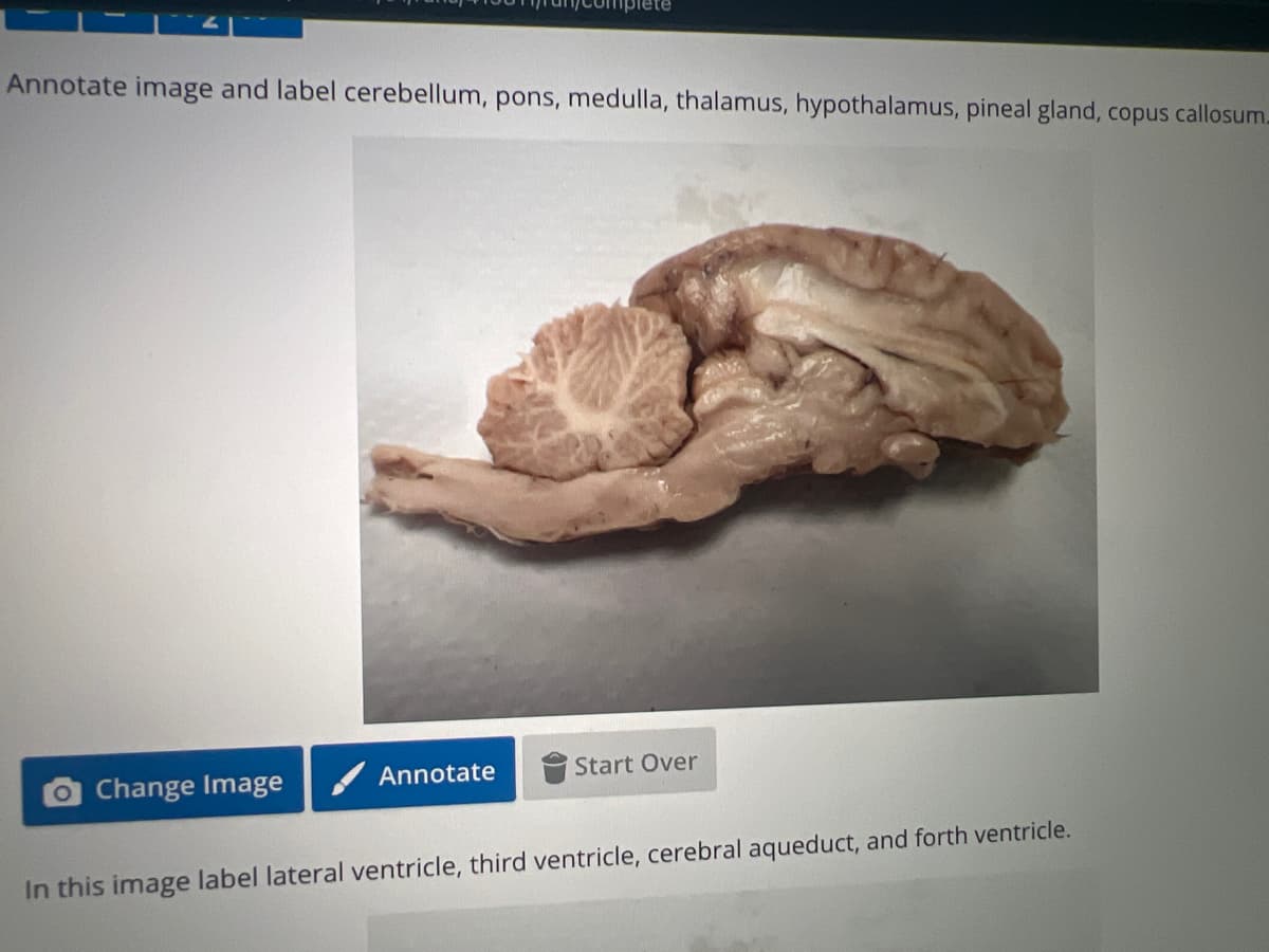 Annotate image and label cerebellum, pons, medulla, thalamus, hypothalamus, pineal gland, copus callosum.
O Change Image
Annotate
Start Over
In this image label lateral ventricle, third ventricle, cerebral aqueduct, and forth ventricle.