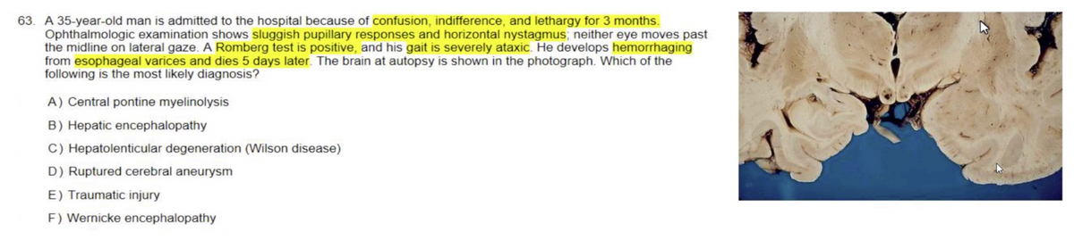 63. A 35-year-old man is admitted to the hospital because of confusion, indifference, and lethargy for 3 months.
Ophthalmologic examination shows sluggish pupillary responses and horizontal nystagmus; neither eye moves past
the midline on lateral gaze. A Romberg test is positive, and his gait is severely ataxic. He develops hemorrhaging
from esophageal varices and dies 5 days later. The brain at autopsy is shown in the photograph. Which of the
following is the most likely diagnosis?
A) Central pontine myelinolysis
B) Hepatic encephalopathy
C) Hepatolenticular degeneration (Wilson disease)
D) Ruptured cerebral aneurysm
E) Traumatic injury
F) Wernicke encephalopathy