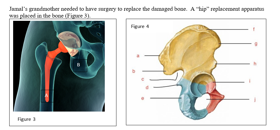Jamal's grandmother needed to have surgery to replace the damaged bone. A "hip" replacement apparatus
was placed in the bone (Figure 3).
Figure 3
A
B
Figure 4
a
f
g
h
j