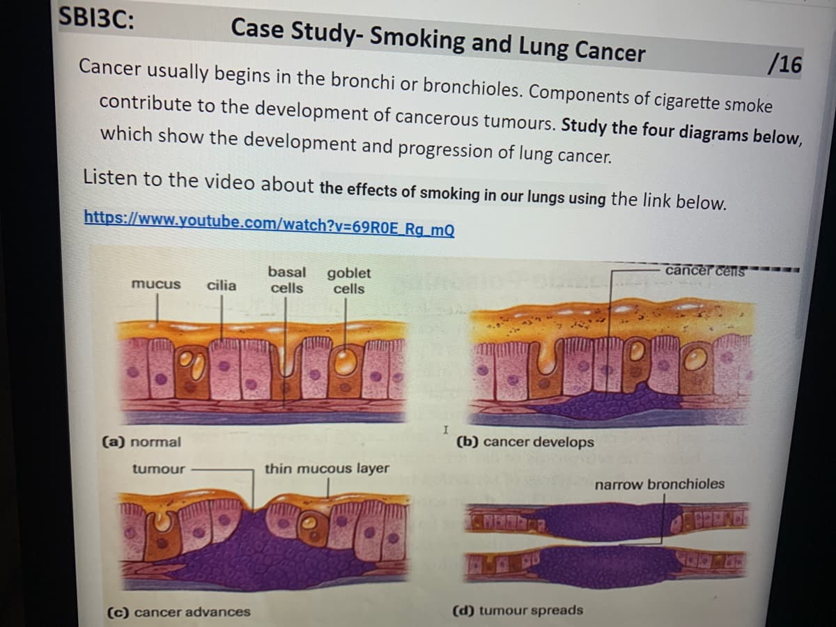 Case Study-Smoking and Lung Cancer
/16
SB13C:
Cancer usually begins in the bronchi or bronchioles. Components of cigarette smoke
contribute to the development of cancerous tumours. Study the four diagrams below,
which show the development and progression of lung cancer.
Listen to the video about the effects of smoking in our lungs using the link below.
https://www.youtube.com/watch?v=69ROE_Rg_mQ
cancer cens
basal goblet
cells cells
mucus
cilia
I
(a) normal
(b) cancer develops
tumour
thin mucous layer
PEERER
(d) tumour spreads
(c) cancer advances
narrow bronchioles