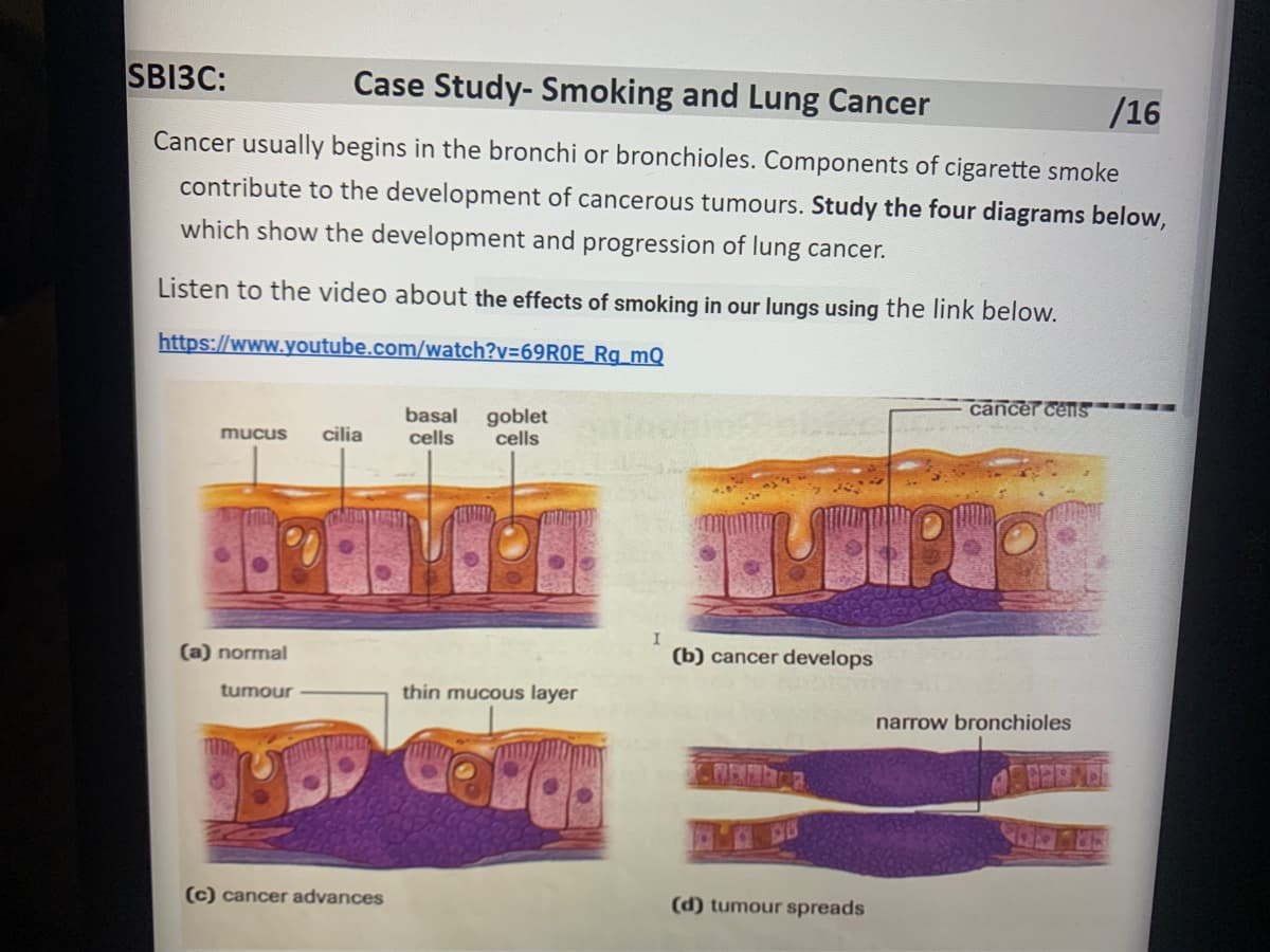 SB13C:
Case Study-Smoking and Lung Cancer
/16
Cancer usually begins in the bronchi or bronchioles. Components of cigarette smoke
contribute to the development of cancerous tumours. Study the four diagrams below,
which show the development and progression of lung cancer.
Listen to the video about the effects of smoking in our lungs using the link below.
https://www.youtube.com/watch?v=69R0E_Rg_mQ
-
cancer cells
basal goblet
cells cells
mucus
cilia
(a) normal
(b) cancer develops
tumour
thin mucous layer
(d) tumour spreads
TUR
(c) cancer advances
narrow bronchioles