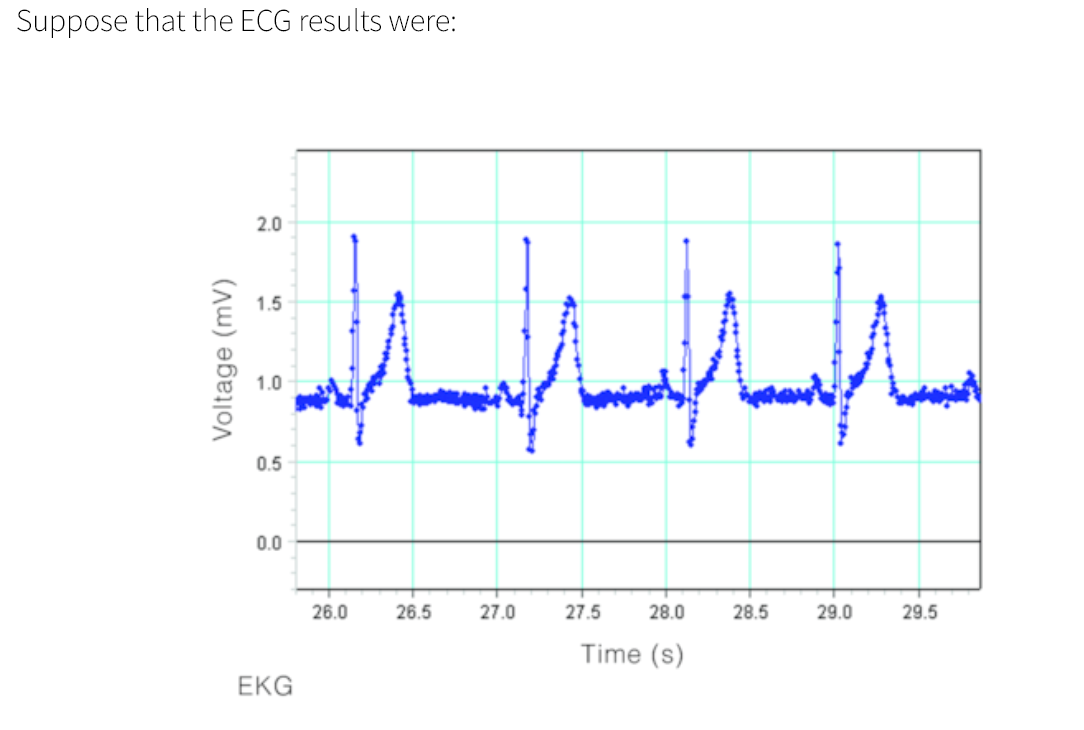 Suppose that the ECG results were:
2.0
1.5
1.0
0.5
0.0
26.0
26.5
27.0
27.5
28.0
28.5
29.0
29.5
Time (s)
EKG
Voltage (mV)
