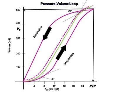 Pressure-Volume Loop
500
UIP
400
V,
300
200
100
LIP
8
12
16
20 24
PIP
P(cm H,0)
Volume (ml)
Expiration
Inspiration

