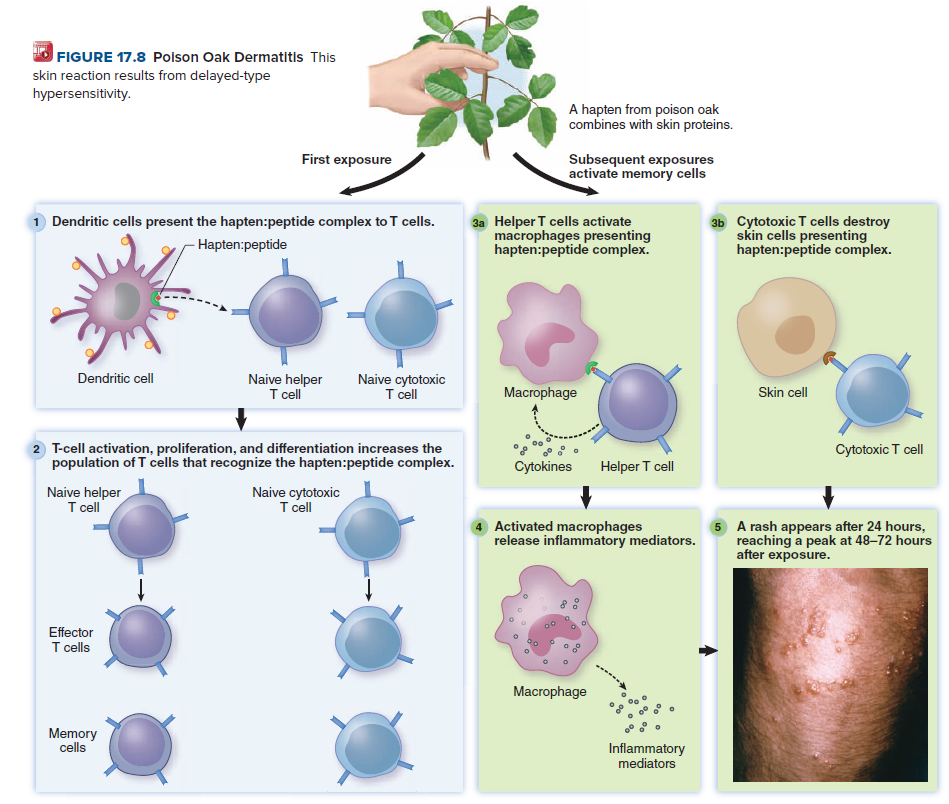 FIGURE 17.8 Polson Oak Dermatitis This
skin reaction results from delayed-type
hypersensitivity.
A hapten from poison oak
combines with skin proteins.
First exposure
Subsequent exposures
activate memory cells
1 Dendritic cells present the hapten:peptide complex to T cells.
3a Helper T cells activate
macrophages presenting
hapten:peptide complex.
3b Cytotoxic T cells destroy
skin cells presenting
hapten:peptide complex.
Hapten:peptide
Dendritic cell
Naive helper
T cell
Naive cytotoxic
T cell
Macrophage
Skin cell
2 T-cell activation, proliferation, and differentiation increases the
population of T cells that recognize the hapten:peptide complex.
Cytotoxic T cell
Cytokines
Helper T cell
Naive helper
T cell
Naive cytotoxic
T cell
Activated macrophages
release inflammatory mediators.
5 A rash appears after 24 hours,
reaching a peak at 48–72 hours
after exposure.
Effector
T cells
Macrophage
Memory
cells
Inflammatory
mediators
