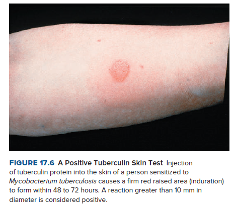 FIGURE 17.6 A Positive Tuberculin Skin Test Injection
of tuberculin protein into the skin of a person sensitized to
Mycobacterium tuberculosis causes a firm red raised area (induration)
to form within 48 to 72 hours. A reaction greater than 10 mm in
diameter is considered positive.
