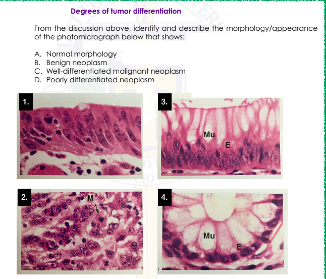 Degrees of tumor differentiation
From the discussion above, identify and describe the morphology/appearance
of the photomicrograph below that shows:
A. Normal morphology
B. Benign neoplasm
C. Well-differentiated malignant neoplasm
D. Poorly differentiated neoplasm
3.
Mu
E
2.
4.
Mu
