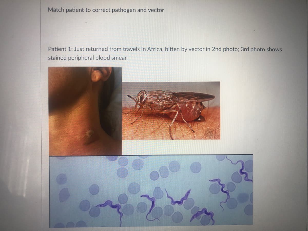 Match patient to correct pathogen and vector
Patient 1: Just returned from travels in Africa, bitten by vector in 2nd photo; 3rd photo shows
stained peripheral blood smear
