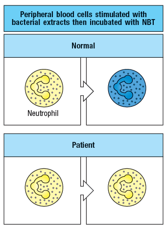 Peripheral blood cells stimulated with
bacterial extracts then incubated with NBT
Normal
Neutrophil
Patient
