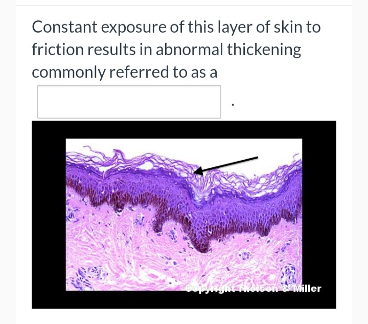 Constant exposure of this layer of skin to
friction results in abnormal thickening
commonly referred to as a
Miller
