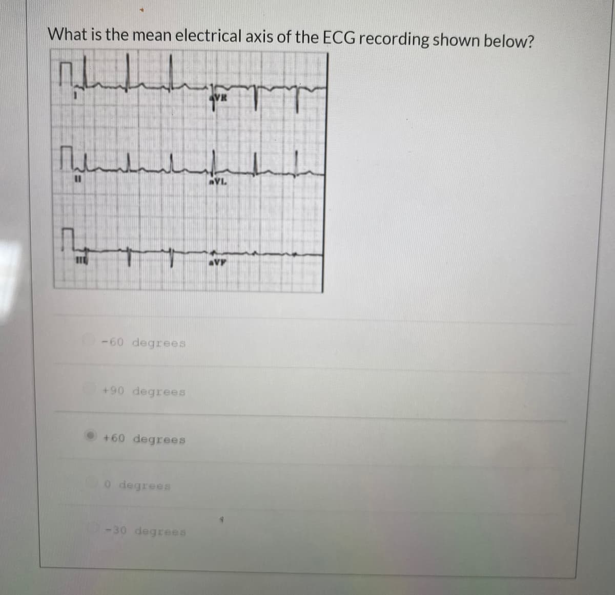 What is the mean electrical axis of the ECG recording shown below?
VR
مل لسمليا
%3D
VL
aVP
-60 degrees
+90 degrees
+60 degrees
0 degrees
-30 degrees
