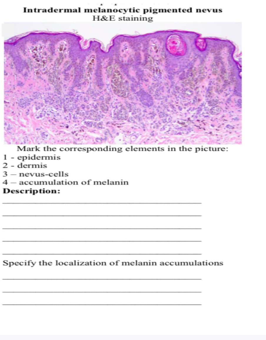 Intradermal melanocytic pigmented nevus
H&E staining
Mark the corresponding elements in the picture:
1 - epidermis
2 - dermis
3- nevus-cells
4- accumulation of melanin
Description:
Specify the localization of melanin accumulations