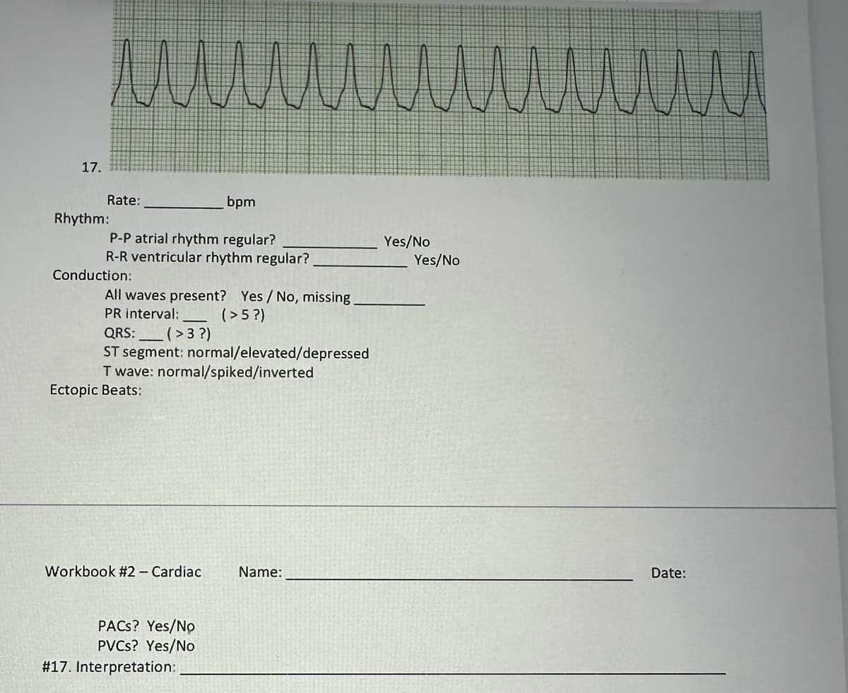 17.
wwwwwwwww
bpm
P-P atrial rhythm regular?
R-R ventricular rhythm regular?
Rate:
Rhythm:
Conduction:
All waves present? Yes/No, missing.
PR interval:
(>5?)
QRS:
(> 3?)
ST segment: normal/elevated/depressed
T wave: normal/spiked/inverted
Ectopic Beats:
Workbook #2 - Cardiac
PACS? Yes/No
PVCs? Yes/No
# 17. Interpretation:
Name:
Yes/No
Yes/No
Date: