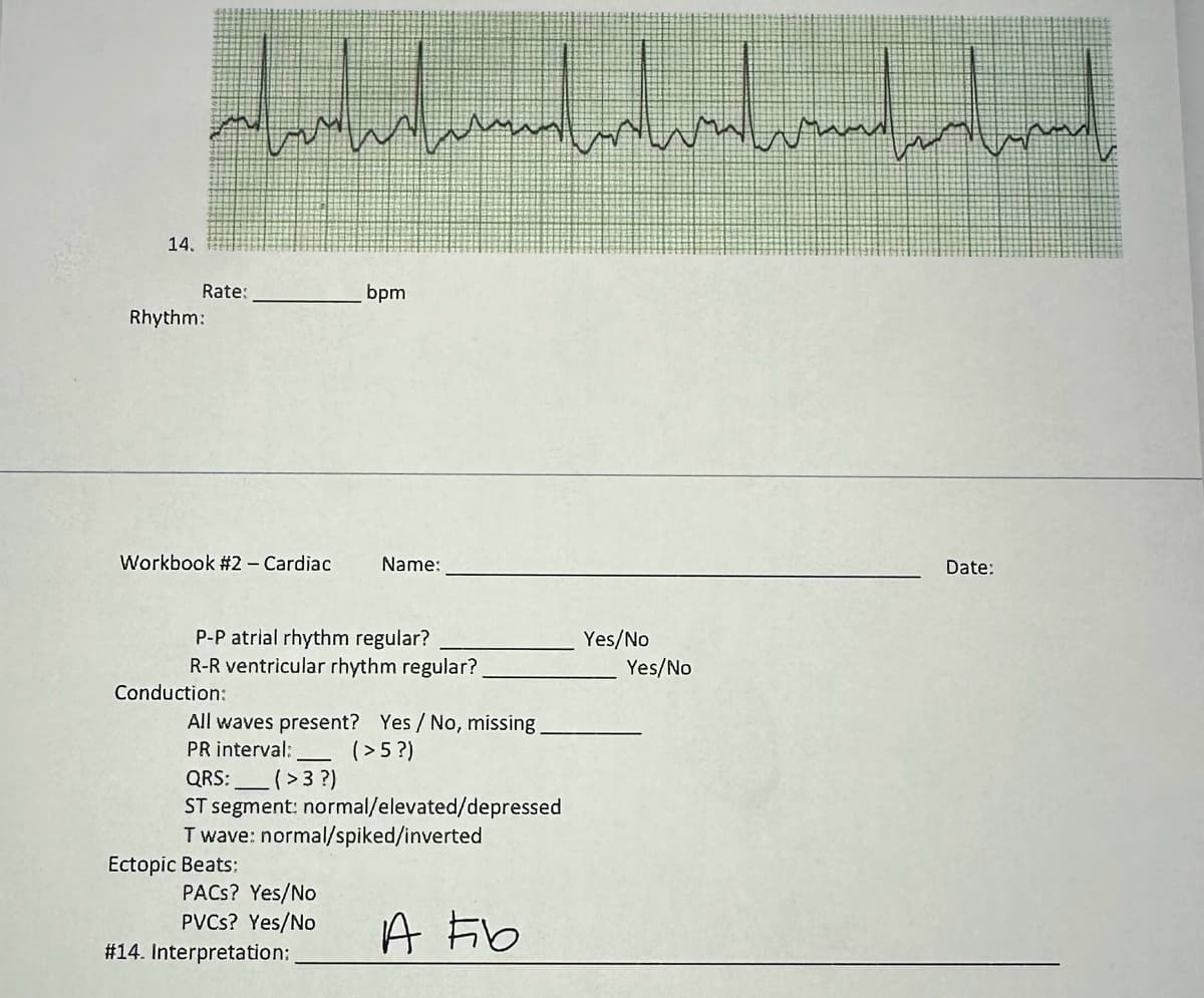 14.
Rate:
Rhythm:
Workbook #2 - Cardiac
H
www
Conduction:
P-P atrial rhythm regular?
R-R ventricular rhythm regular?
Ectopic Beats:
bpm
All waves present? Yes/No, missing.
PR interval:
(>5?)
Name:
QRS: (> 3?)
ST segment: normal/elevated/depressed
Twave: normal/spiked/inverted
A Fib
PACS? Yes/No
PVCs? Yes/No
#14. Interpretation:
Yes/No
Yes/No
الستين الله
Date:
احمد