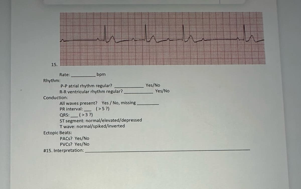 15.
Rate:
bpm
P-P atrial rhythm regular?
R-R ventricular rhythm regular?
Rhythm:
Conduction:
All waves present? Yes/No, missing.
PR interval:
(>5?)
minim
QRS:
(>3 ?)
ST segment: normal/elevated/depressed
T wave: normal/spiked/inverted
Ectopic Beats:
PACS? Yes/No
PVCs? Yes/No
# 15. Interpretation:
Yes/No
Yes/No