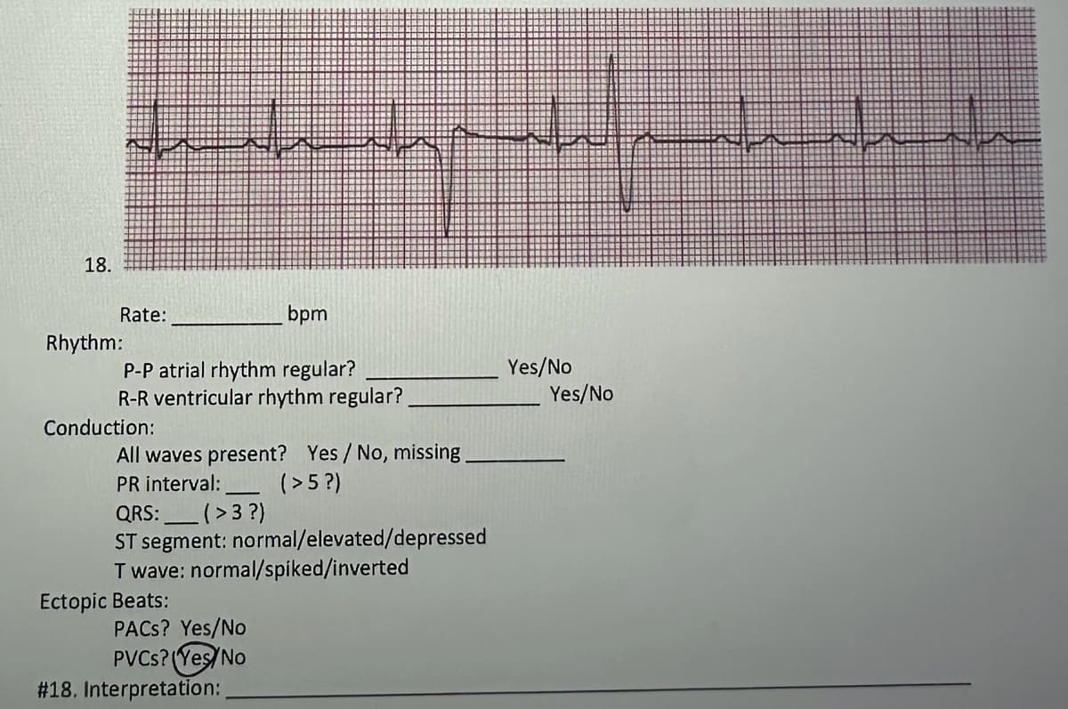 18.
bpm
P-P atrial rhythm regular?
R-R ventricular rhythm regular?
Rate:
Rhythm:
Conduction:
All waves present? Yes / No, missing
PR interval:
(>5?)
QRS:
(>3 ?)
ST segment: normal/elevated/depressed
T wave: normal/spiked/inverted
Ectopic Beats:
PACs? Yes/No
PVCs? (Yes/No
# 18. Interpretation:
Yes/No
F 1
Yes/No
Shah