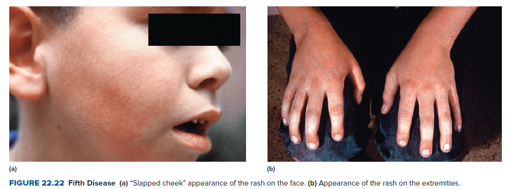 (a)
(b)
FIGURE 22.22 Fifth Disease (a) "Slapped cheek" appearance of the rash on the face. (b) Appearance of the rash on the extremities.
