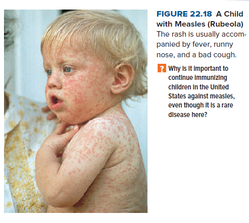 FIGURE 22.18 A Child
with Measles (Rubeola)
The rash is usually accom-
panied by fever, runny
nose, and a bad cough.
2 Why Is It important to
continue Immunizing
children in the United
States against measles,
even though It Is a rare
disease here?
