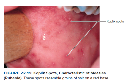 -Koplik spots
FIGURE 22.19 Koplik Spots, Characteristic of Measles
(Rubeola) These spots resemble grains of salt on a red base.
