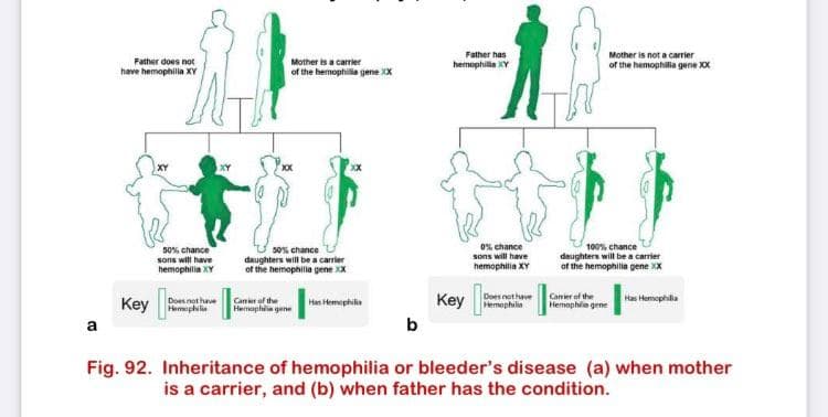 Father has
hemophilia XY
Mother is not a caerier
Father does not
Mother is a carrier
of the hemophilia gene XX
of the hemophillia gene XX
have hemophila XY
50% chance
sons will have
hemophilia XY
s0% chance
daughters will be a carrier
ot the hemophilla gene XX
0% chance
sons will have
hemophilia XY
100% chance
deughters will be a carrier
of the hemophila gene XX
Caner of the
Hermaphia gene
Key
Does nethave
Hemophilia
Camer of the
Hemophiin gene
Key
Has Hemophila
Does not have
Han Hemophilia
a
b
Fig. 92. Inheritance of hemophilia or bleeder's disease (a) when mother
is a carrier, and (b) when father has the condition.
