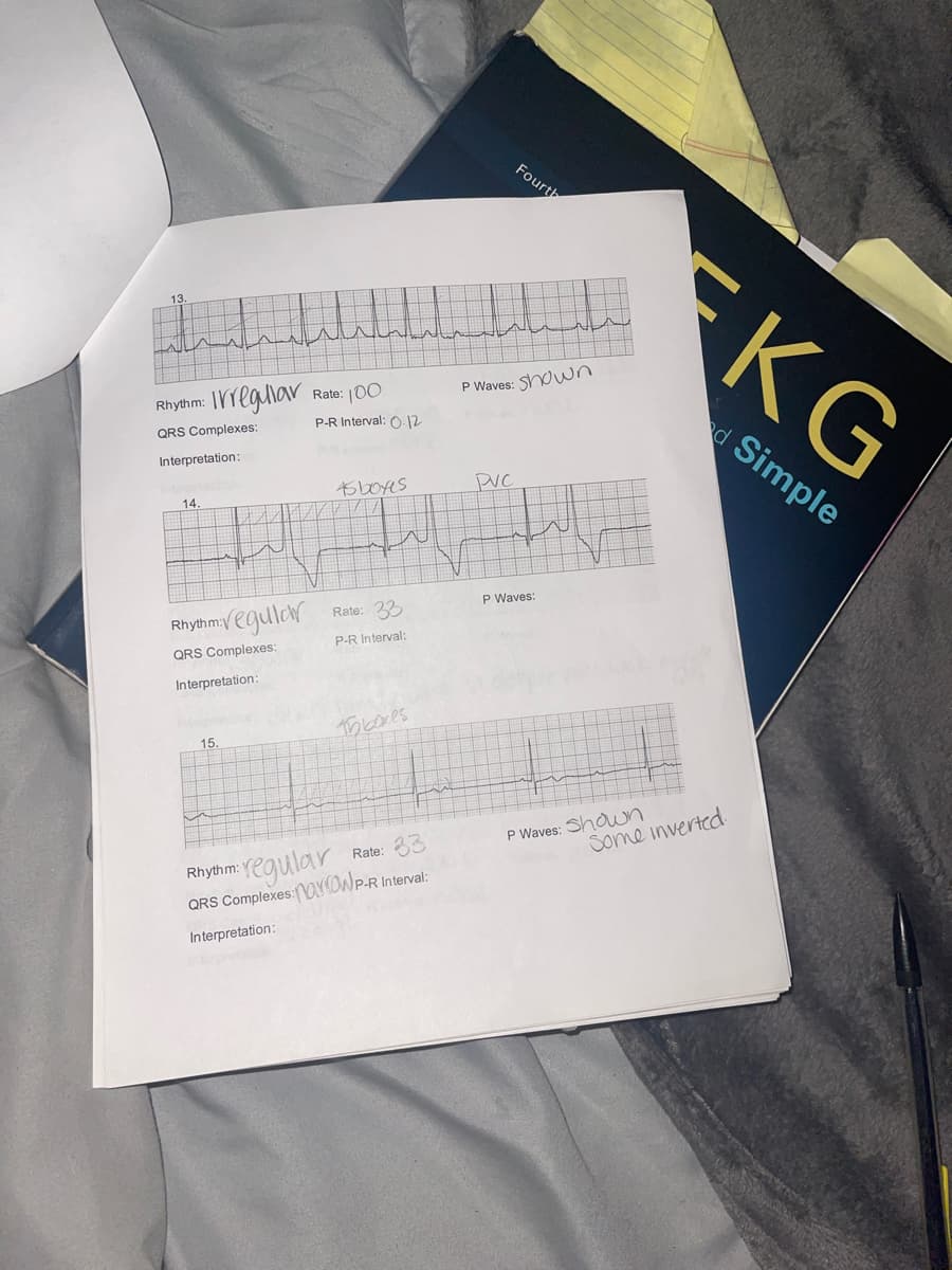 Rate: 100
P-R Interval: 0.12
45 boxes
Rhythm: Irregullav
QRS Complexes:
Interpretation:
14
Rhythm:√egular
QRS Complexes:
Interpretation:
15.
Thboxes
Rhythm:
Rate: 33
regular
QRS Complexes: YOWP-R Interval:
Interpretation:
Rate: 33
P-R Interval:
Fourth
P Waves: Shown
PVC
P Waves:
P Waves: Shown
Some inverted.
KG
Simple