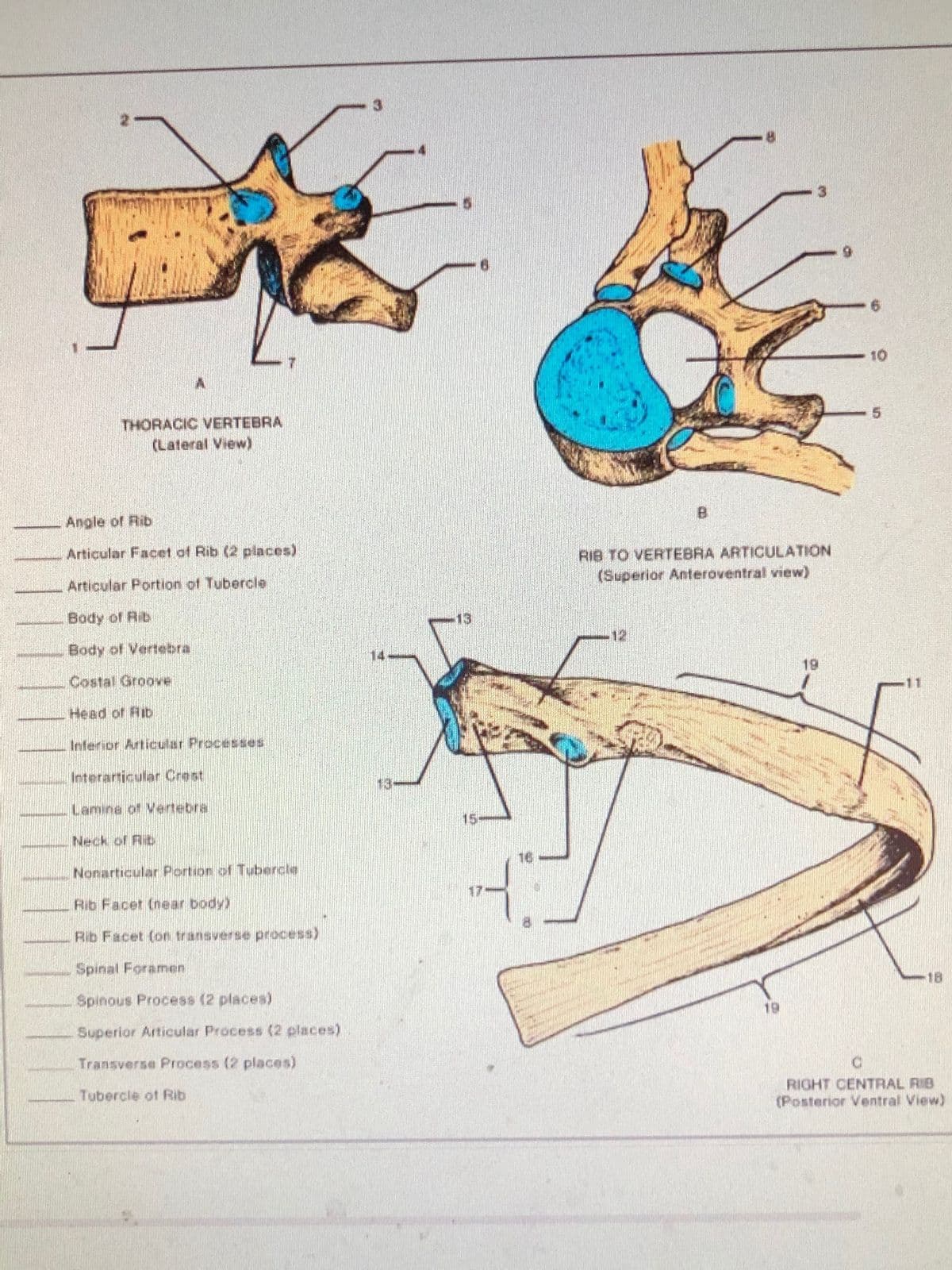 THORACIC VERTEBRA
(Lateral View)
Angle of Rib
Articular Facet of Rib (2 places)
Articular Portion of Tubercle
Body of Rib
Body of Vertebra
Costal Groove
Head of lib
Inferior Articular Processes
Interarticular Crest
Lamina of Vertebra
Neck of Ri
Nonarticular Portion of Tubercle
Rib Facet (near body)
Rib Facet (on transverse process)
Spinal Foramen
Spinous Process (2 places)
Superior Articular Process (2 places)
Transverse Process (2 places)
Tubercle of Rib
14
13-
13
15:
17
16
B
RIB TO VERTEBRA ARTICULATION
(Superior Anteroventral view)
12
19
10
18
C
RIGHT CENTRAL RIB
(Posterior Ventral View)