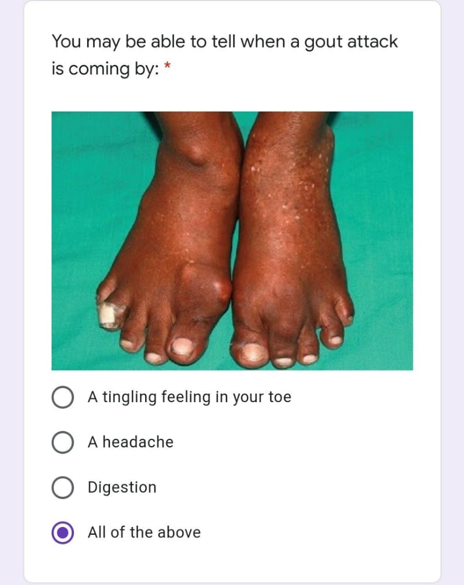 You may be able to tell when a gout attack
is coming by: *
A tingling feeling in your toe
O A headache
Digestion
All of the above
