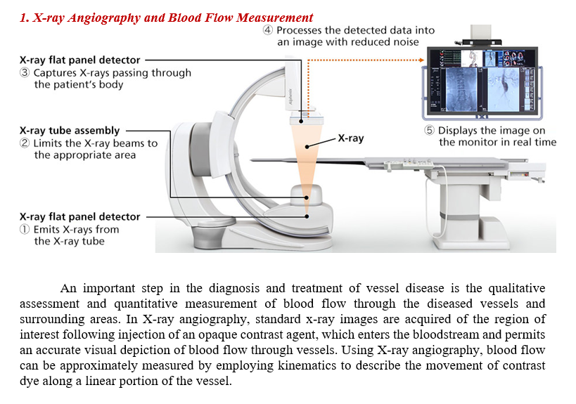 1. X-ray Angiography and Blood Flow Measurement
X-ray flat panel detector
3 Captures X-rays passing through
the patient's body
X-ray tube assembly
2 Limits the X-ray beams to
the appropriate area
X-ray flat panel detector
1 Emits X-rays from
the X-ray tube
4 Processes the detected data into
an image with reduced noise
-X-ray
EXECIK
6
e kujte te toe te
GA
5 Displays the image on
the monitor in real time
An important step in the diagnosis and treatment of vessel disease is the qualitative
assessment and quantitative measurement of blood flow through the diseased vessels and
surrounding areas. In X-ray angiography, standard x-ray images are acquired of the region of
interest following injection of an opaque contrast agent, which enters the bloodstream and permits
an accurate visual depiction of blood flow through vessels. Using X-ray angiography, blood flow
can be approximately measured by employing kinematics to describe the movement of contrast
dye along a linear portion of the vessel.