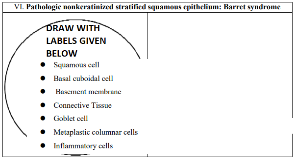 VI. Pathologic nonkeratinized stratified squamous epithelium: Barret syndrome
DRAW WITH
LABELS GIVEN
BELOW
Squamous cell
• Basal cuboidal cell
Basement membrane
• Connective Tissue
Goblet cell
Metaplastic columnar cells
Inflammatory cells