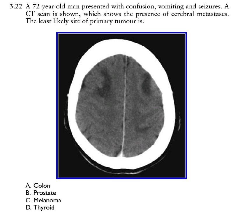 3.22 A 72-year-old man presented with confusion, vomiting and seizures. A
CT scan is shown, which shows the presence of cerebral metastases.
The least likely site of primary tumour is:
A. Colon
B. Prostate
C. Melanoma
D. Thyroid
