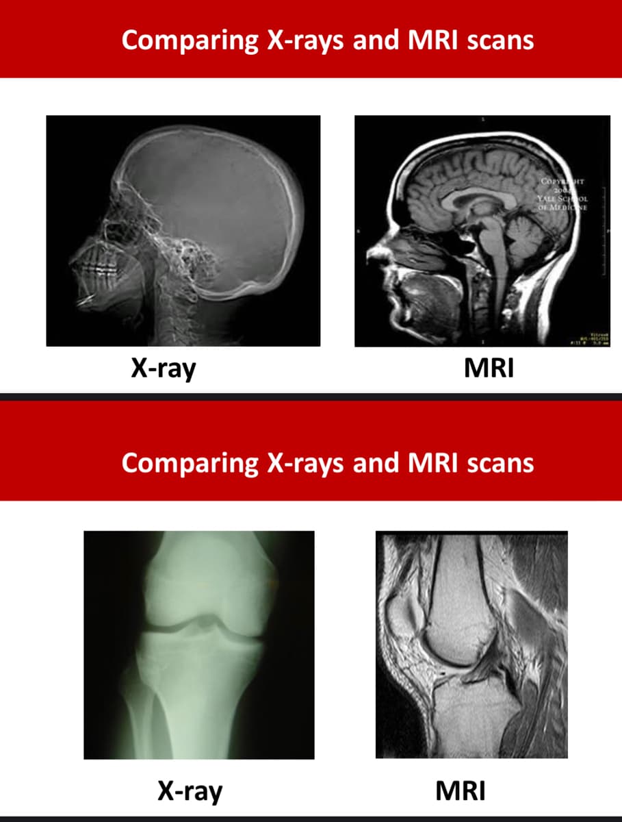 Comparing X-rays and MRI scans
COPY T
YALE SCHOL
OF MEDINE
X-ray
MRI
Comparing X-rays and MRI scans
X-ray
MRI
