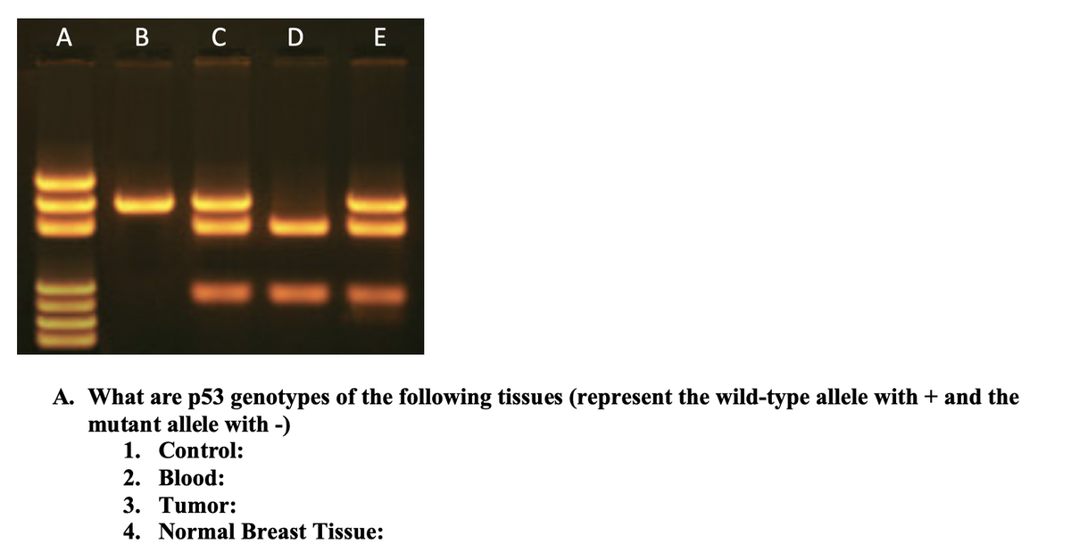 A B C D E
A. What are p53 genotypes of the following tissues (represent the wild-type allele with + and the
mutant allele with -)
1. Control:
2. Blood:
3. Tumor:
4. Normal Breast Tissue:
