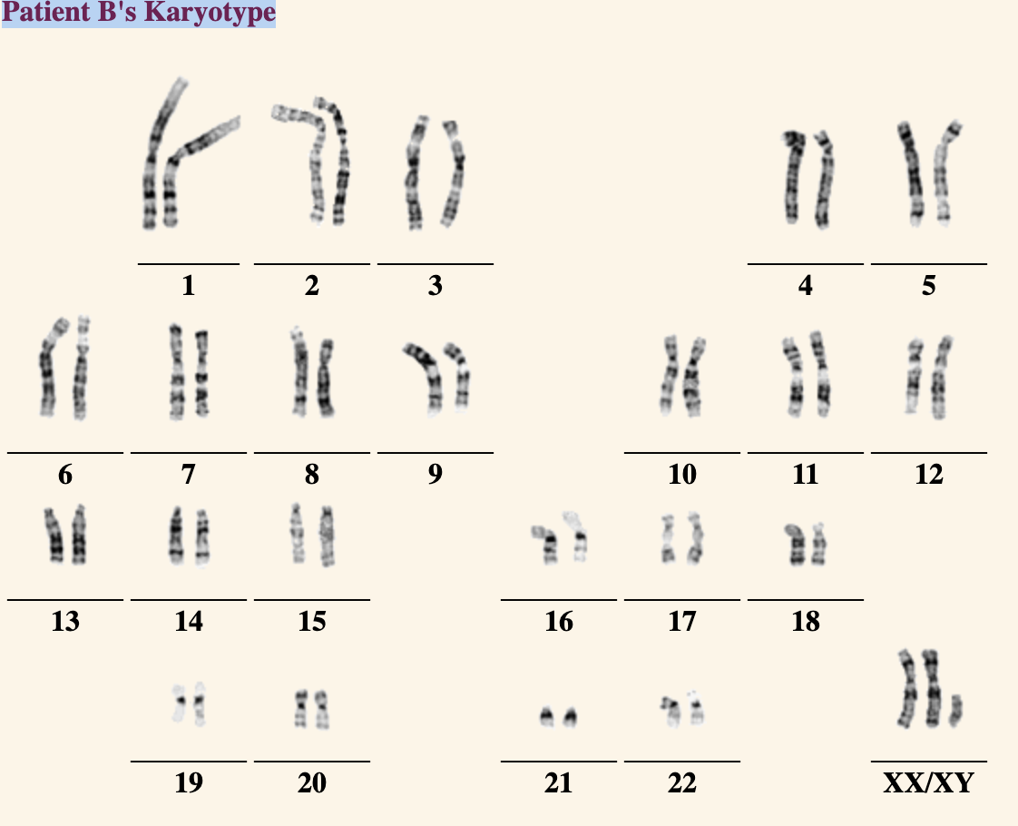 Patient B's Karyotype
13
7
14
19
7
2
8
15
20
3
.
TR
16
21
10
17
22
ܐܐ
11
18
V
5
12
L
XX/XY