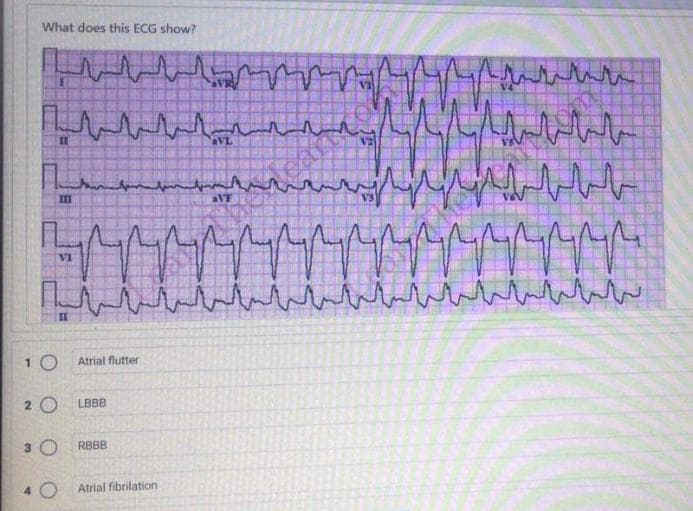 What does this ECG show?
II
VL
VI
1 0
Atrial flutter
2 0
LBBB
3 O
RBBB
40
Atrial fibrilation
