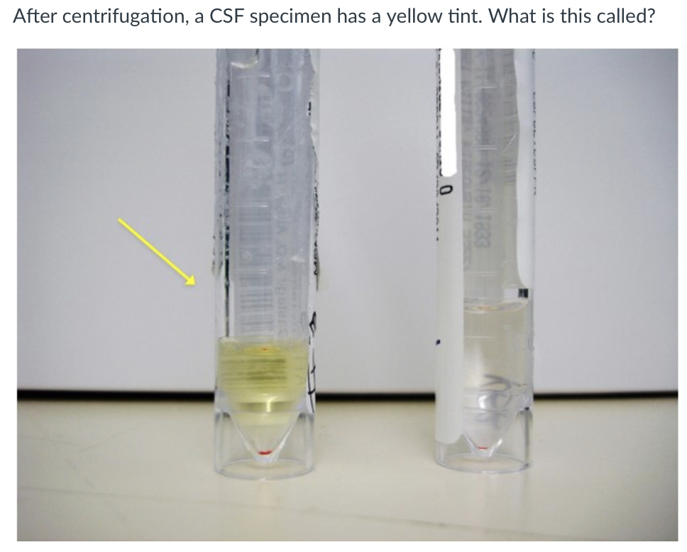After centrifugation, a CSF specimen has a yellow tint. What is this called?
