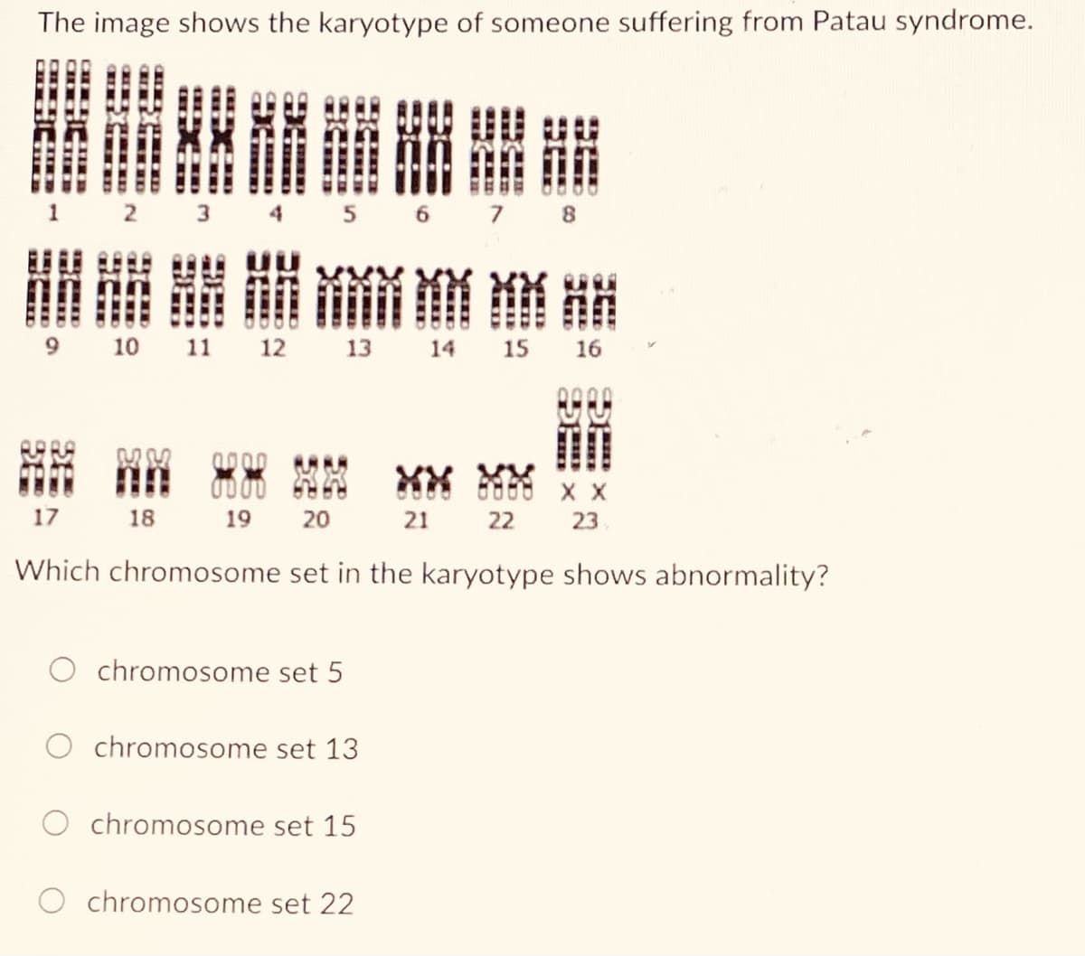 The image shows the karyotype of someone suffering from Patau syndrome.
1
2 3 4 5 6
7 8
開講罪崩崩崩销
10
11
12
13
14
15
16
17
18
19
20
21
22
23
Which chromosome set in the karyotype shows abnormality?
chromosome set 5
chromosome set 13
O chromosome set 15
chromosome set 22
