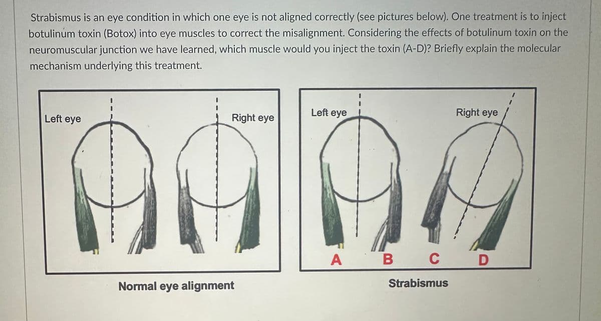 Strabismus is an eye condition in which one eye is not aligned correctly (see pictures below). One treatment is to inject
botulinum toxin (Botox) into eye muscles to correct the misalignment. Considering the effects of botulinum toxin on the
neuromuscular junction we have learned, which muscle would you inject the toxin (A-D)? Briefly explain the molecular
mechanism underlying this treatment.
Left eye
Right eye
Normal eye alignment
Left eye
Right eye
A B C D
D
Strabismus