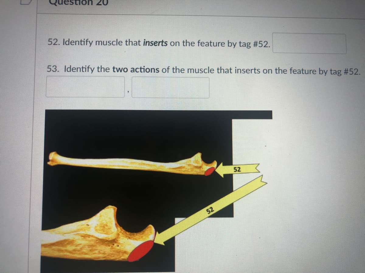 1on 20
52. Identify muscle that inserts on the feature by tag #52.
53. Identify the two actions of the muscle that inserts on the feature by tag #52.
52
52
