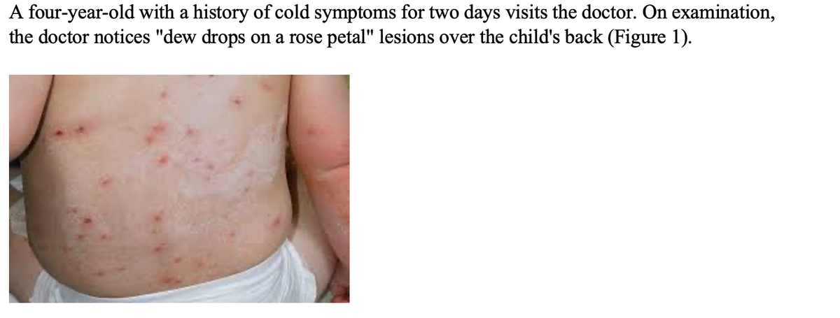 A four-year-old with a history of cold symptoms for two days visits the doctor. On examination,
the doctor notices "dew drops on a rose petal" lesions over the child's back (Figure 1).