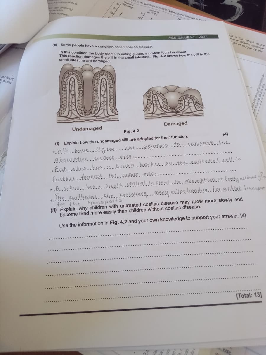 developing
my and rende
hope to prevent
C
20-
10
30-
Show the quantities of selected vitamins and minerals in f
vitamin C
mg/100g
vitamin D
g/100g
154
orders mo
(c) Some people have a condition called coeliac disease.
ASSIGNMENT -2024
In this condition the body reacts to eating gluten, a protein found in wheat.
This reaction damages the villi in the small intestine. Fig. 4.2 shows how the villl in the
small intestine are damaged.
od is the richest source
min or mineral essential
oort of oxygen by the
and height,
troduction
Undamaged
Fig. 4.2
Damaged
(1) Explain how the undamaged villi are adapted for their function.
[4]
•killi hese figures like projections to sons....the.
Abaseline.
Each villa....hne a brush back to..ithin..... to
further increase the Surface gisa..
...
Allahan.a. Ringle central la.£tal.....ption..fatty acidaed glo
The spithains vells containing many tesheadus...fex.as.like transp
for the
transports
for
(ii) Explain why children with untreated coeliac disease may grow more slowly and
become tired more easily than children without coeliac disease.
Use the information in Fig. 4.2 and your own knowledge to support your answer. [4]
[Total: 13]
hape