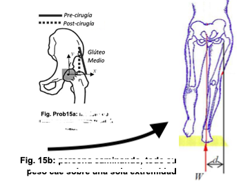 Pre-cirugia
Post-cirugía
Glúteo
Medio
Fig. Prob15a: i.
Fig. 15b: :
Buov vuv ou
